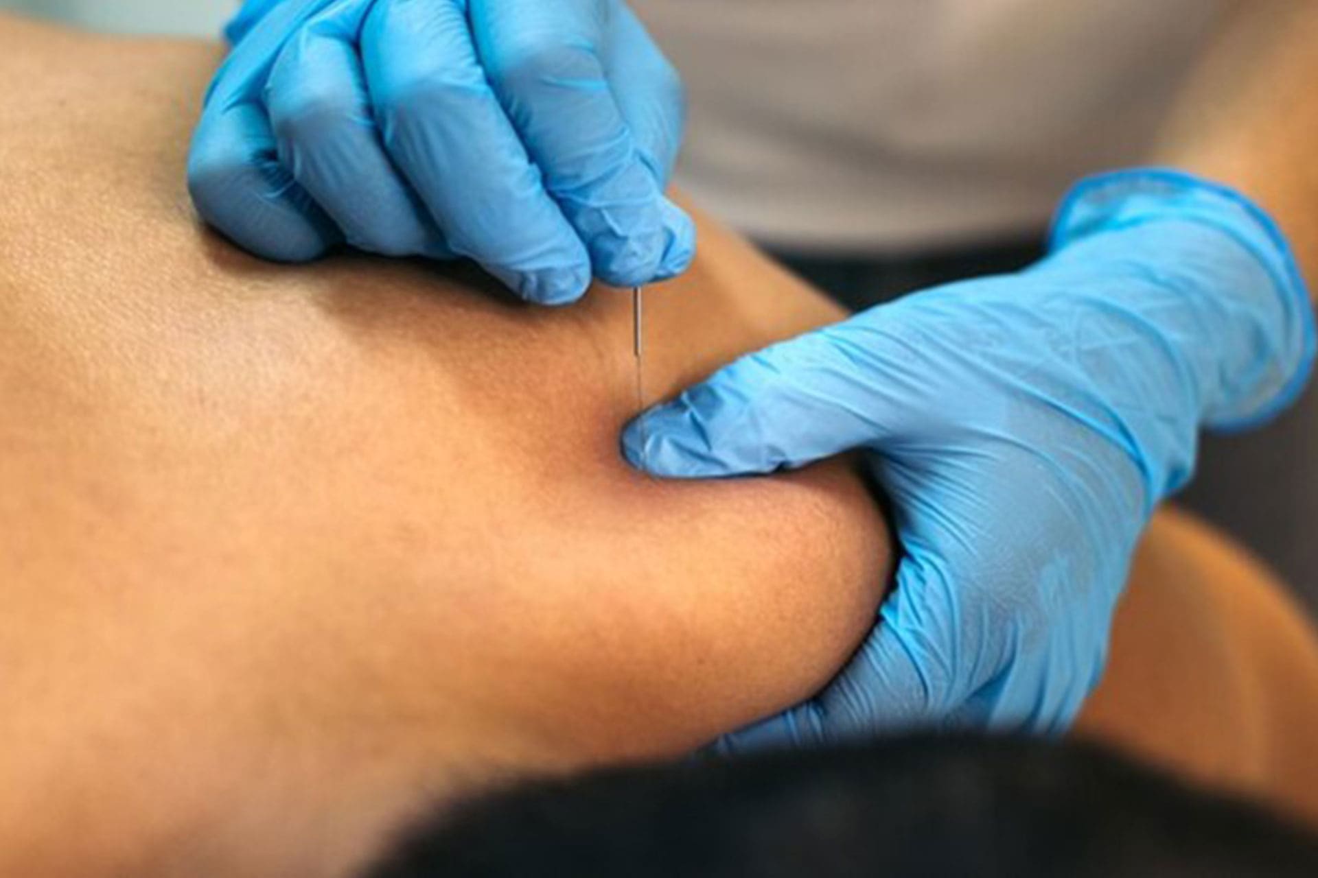 Close-up van behandelende handen tijdens dry needling.